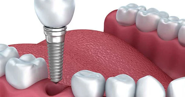 Diş implantının damağa ziyanı varmı?