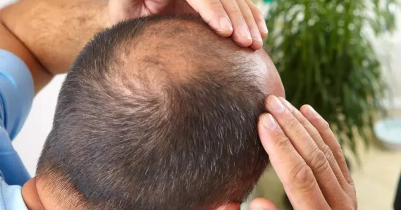 Bahalı şampunlara son! Keçəlliyin təbii MÜALİCƏSİ tapıldı