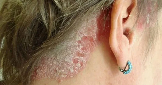 Psoriaza qarşı SİRLİ DƏRMAN