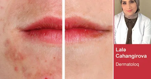 Sızanaqlardan qurtulmaq istəyirsinizsə... Dermatoloqun tövsiyələri