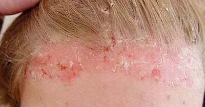 Uşaqlarda psoriaz xəstəliyi