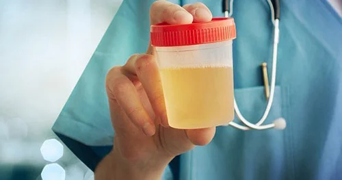 Sidik analizi xərçəngin bu növünü aşkar etməyə kömək edəcək
