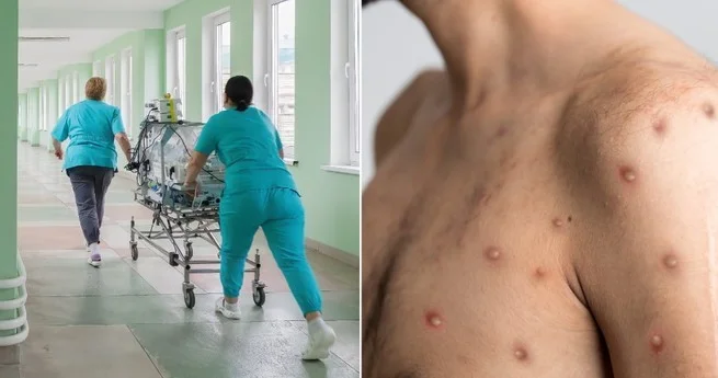 Оспа обезьян распространяется по России, новые случаи выявлены в Петербурге