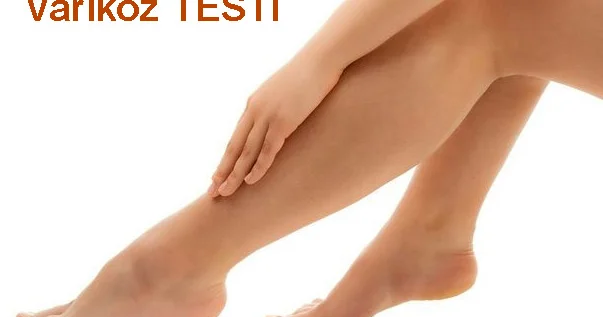 Sizdə varikoz xəstəliyi inkişaf edə bilər? TEST