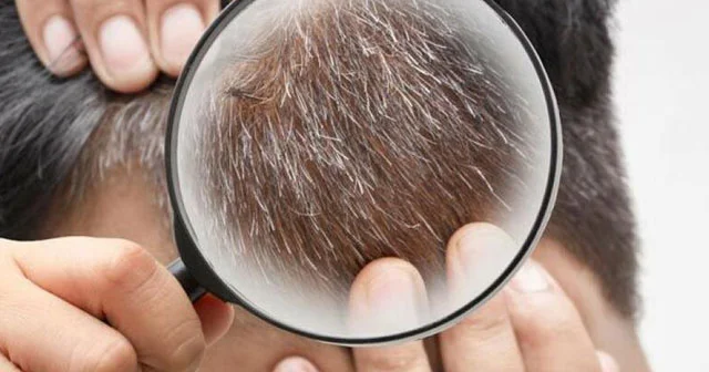 Saçın erkən ağarmasının səbəbi nədir? Mütəxəssis AÇIQLADI