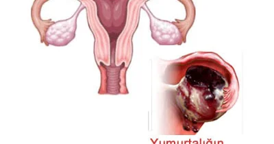 Yumurtalığın yırtılması (yumurtalığın apopleksiyası)