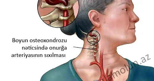 Sizdə boyun osteoxondrozu varmı? TEST