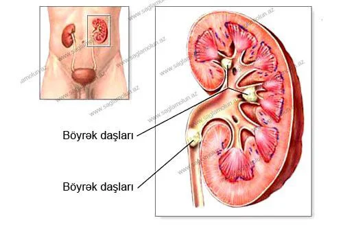 Böyrək daşı xəstəliyi