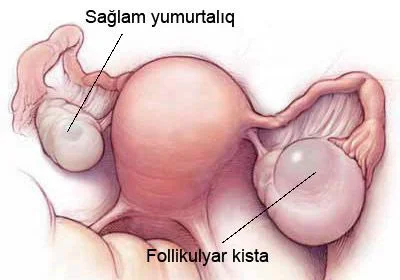 Yumurtalığın funksional kistaları