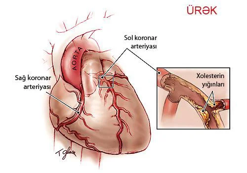 Ürəyin işemik xəstəliyi (ÜİX)