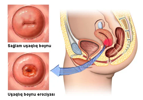 Eroziyanın yandırılması