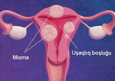 Mioma və hamiləlik