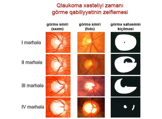 Qlaukomanın simptomları və müalicəsi