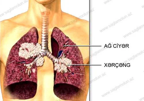 Ağ ciyər xərçəngi. Simptomlar və profilaktika