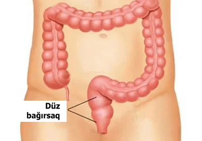 Proktit düz bağırsağın iltihabı