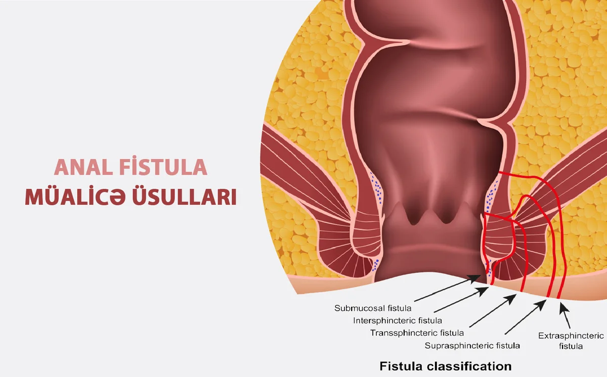 Fistula nə qədər ciddi problemdir? Cərrah açıqlayır