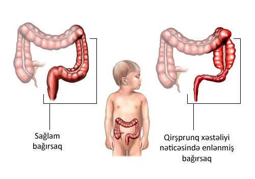 Körpələrdə qəbizliyin təhlükəsi Qirşprunq xəstəliyi