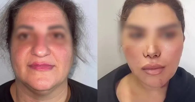 60 yaşlı qadını əməliyyatla bu hala saldılar VİDEO