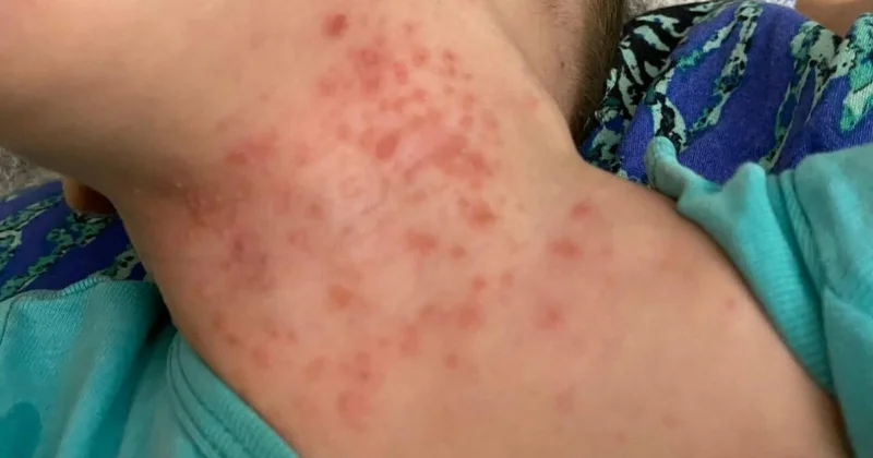 Uşaqlar arasında yeni virus yayılıb? AÇIQLAMA