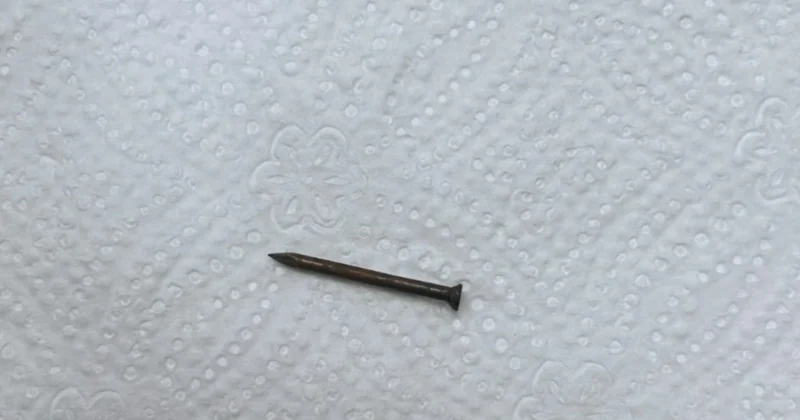 В Баку из желудка ребенка извлекли гвоздь ФОТО