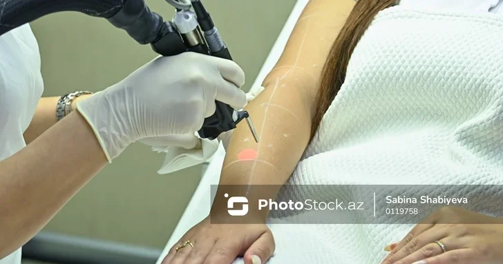 Бум лазерной эпиляции в Азербайджане: кто контролирует безопасность процедур?