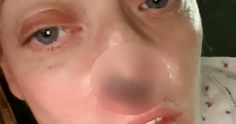 Türkiyədə implant etdirən qadının burnu çürüməyə başladı VİDEO