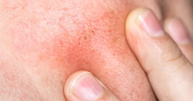 Qışda dəri baryerinə mənfi təsir edən vərdişlər