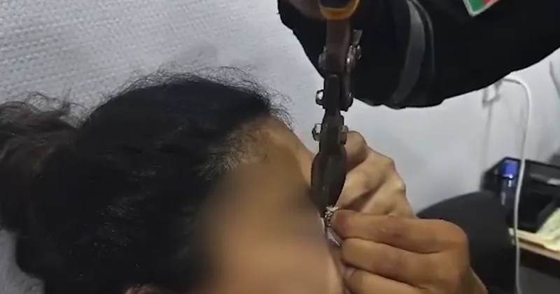 Göz qapağına geyiminin zəncirbəndi ilişdi Video