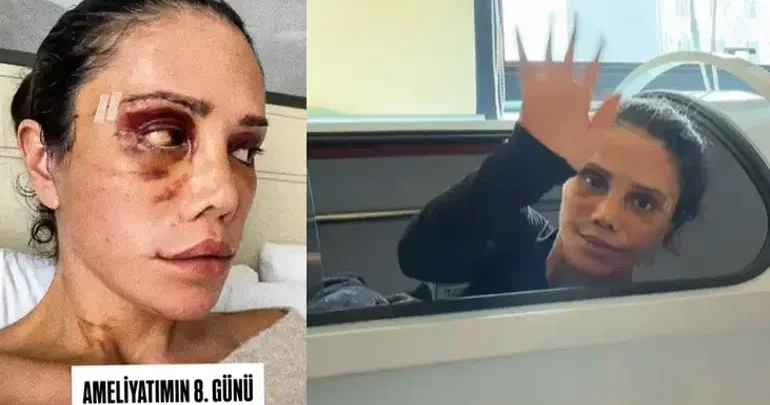 Üz əməliyyatı keçirən Didem Ceran HAMIDAN ÜZR İSTƏDİ