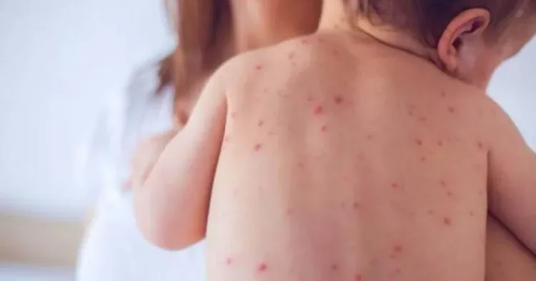 Uşaqlarda dəri xəstəlikləri niyə yaranır? Pediatrdan AÇIQLAMA