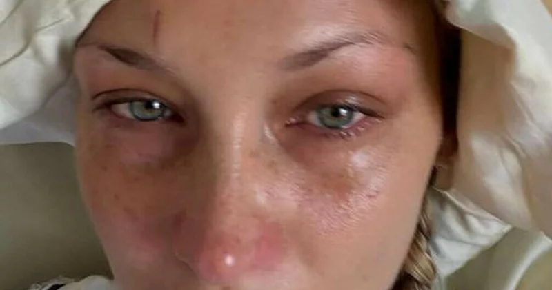 Bella Hadidin xəstəliyi kəskinləşdi
