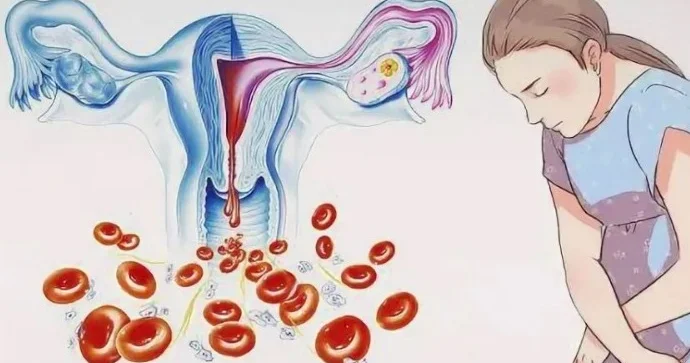 Ayda 2 dəfə mensturasiya normaldırmı? SƏBƏBLƏRİ