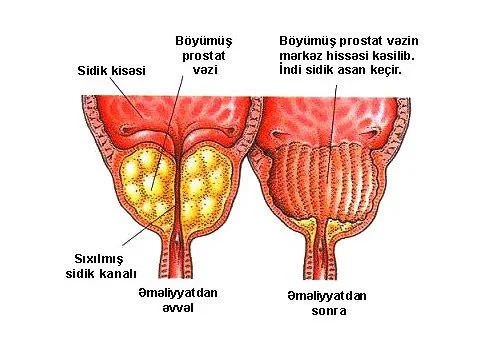 Prostat vəzinin adenoması xoşxassəli şişdir