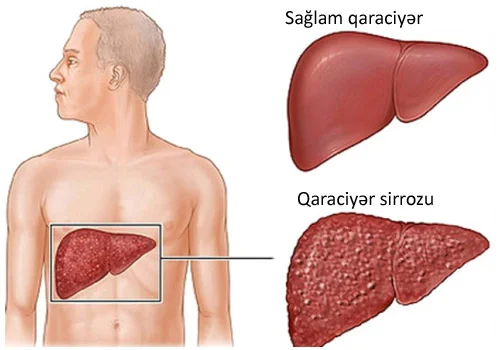 Sirroz müalicə olunurmu?