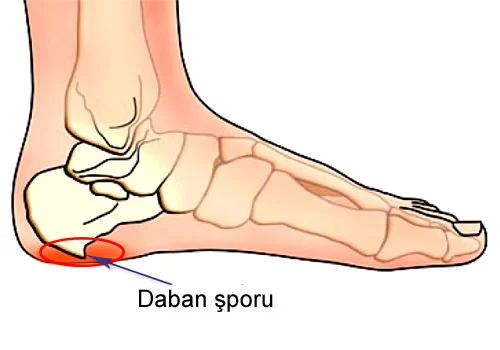 Dabanda ağrıların səbəbi daban şporları