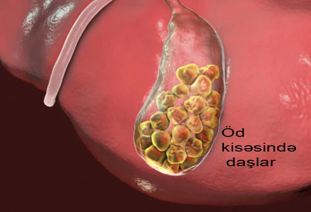 Öd kisəsində daşların yığılmaması üçün nə etmək lazımdır?