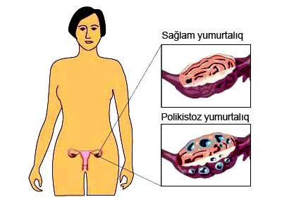 Polikistoz yumurtalıqlar sindromu