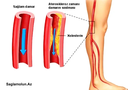 Diqqət! Axsama ciddi xəstəliyin simptomu ola bilər