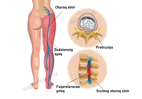 İşias osteoxondrozun ağır fəsadı