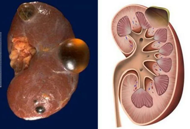 Həkimuroloq: Böyrək kistasının dərman üsulu ilə müalicəsi yoxdur