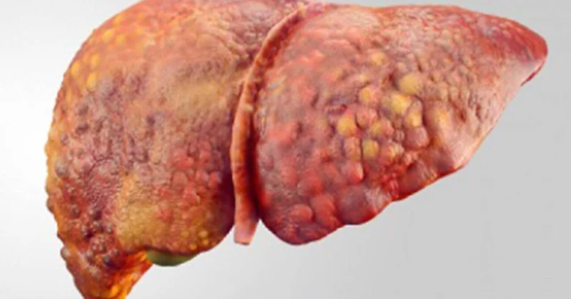 Qaraciyər yağlanıbsa ölüm riski 35 dəfə artır