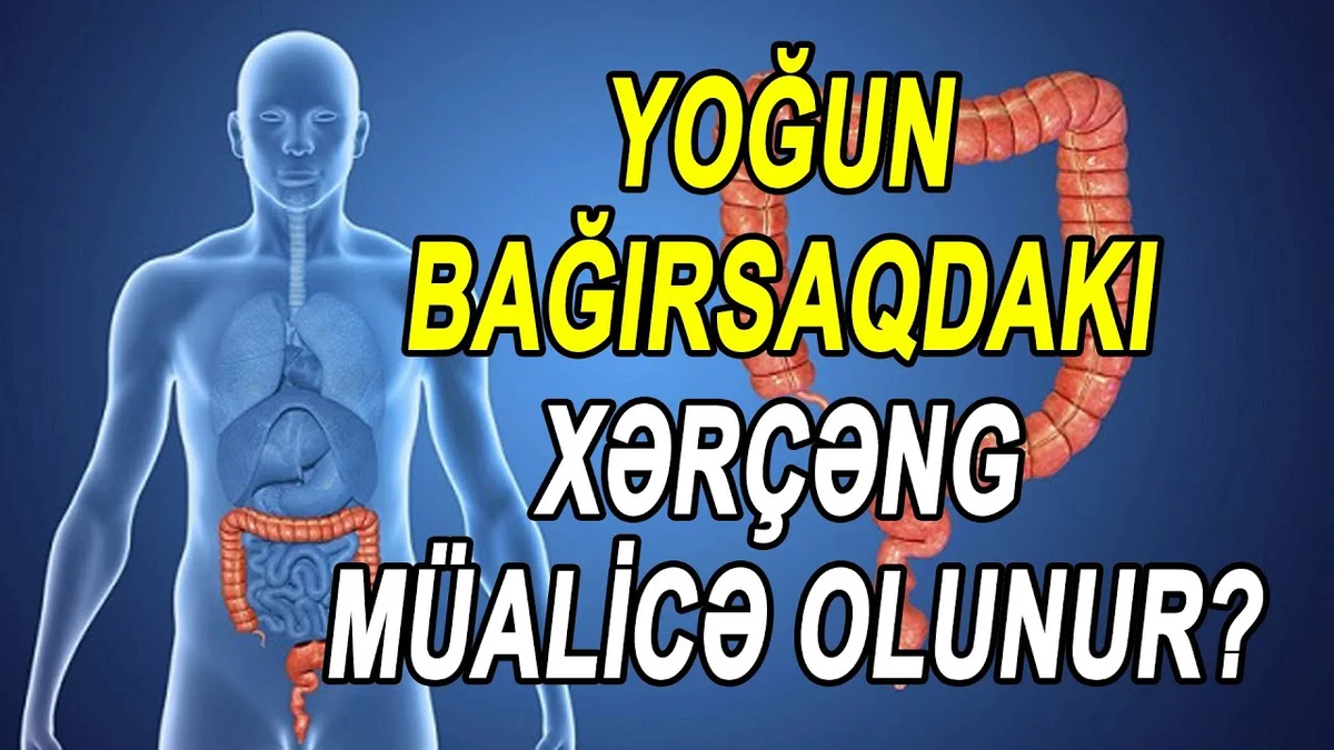 Yoğun bağırsaqdakı xərçəng müalİcə olunur?