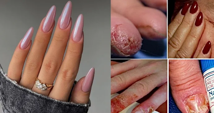 Estetik trend olan süni dırnaq xərçəng xəstəliyinə səbəb olur? Adil Qeybulla AÇIQLADI