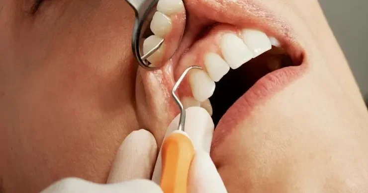 Bu fobiya insanlara dişlərini müntəzəm təmizləməyə və stomatoloqa getməyə mane olur