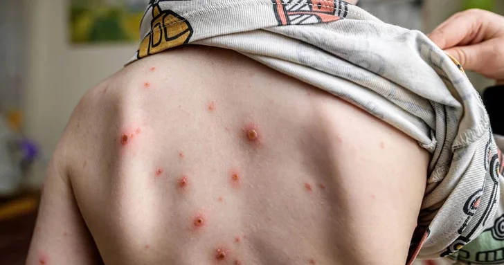 В Азербайджане зафиксирован рост заболеваемости ветряной оспой и другими инфекционными заболеваниями