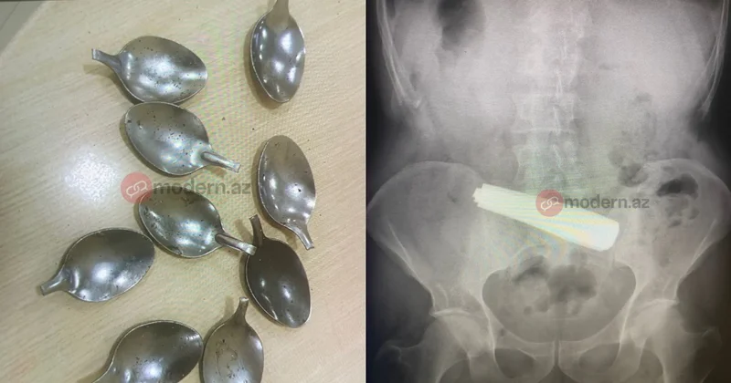 Bakıda bir nəfər 9 ədəd qaşıq uddu ŞOK HADİSƏ FOTOLAR