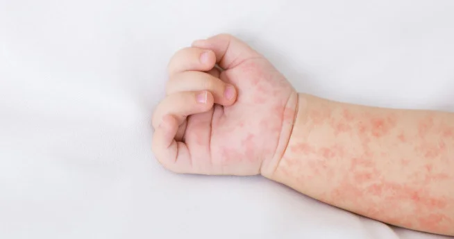 Banqladeşdə qızılca epidemiyası 459 uşağın ölümünə səbəb olub