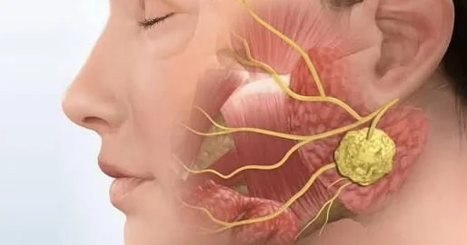 Tüpürcək vəzilərinin şişləri niyə yaranır?