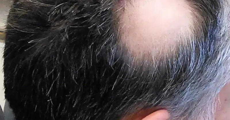 Arıqlamaq üçün məşhur üsul saçları tökə bilər