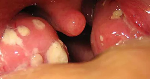 Uşaqlarda angina xəstəliyi Əməliyyatın hansı fəsadları var?